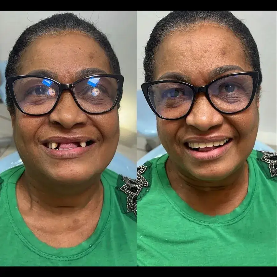 Antes e depois de implante dentário