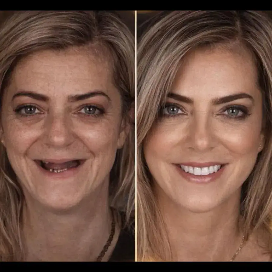Antes e depois de reabilitação do sorriso