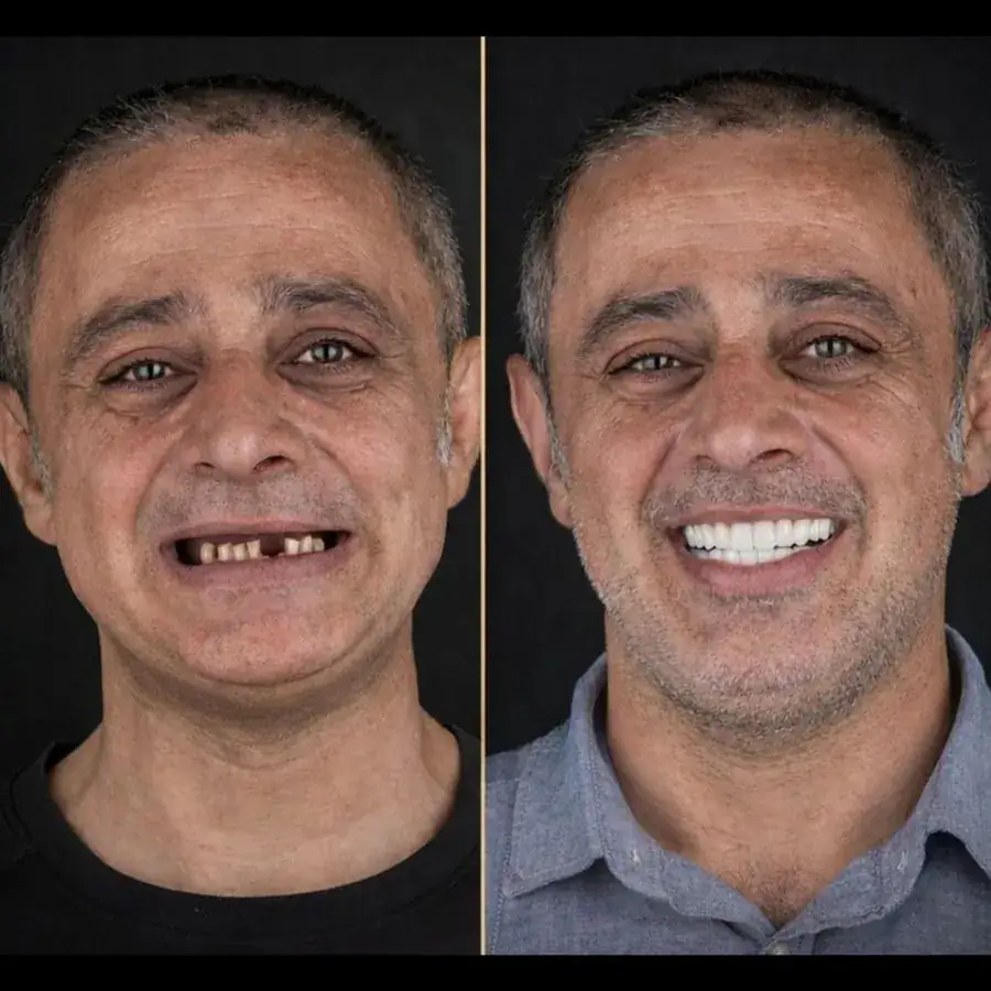 Antes e depois de prótese sobre implante