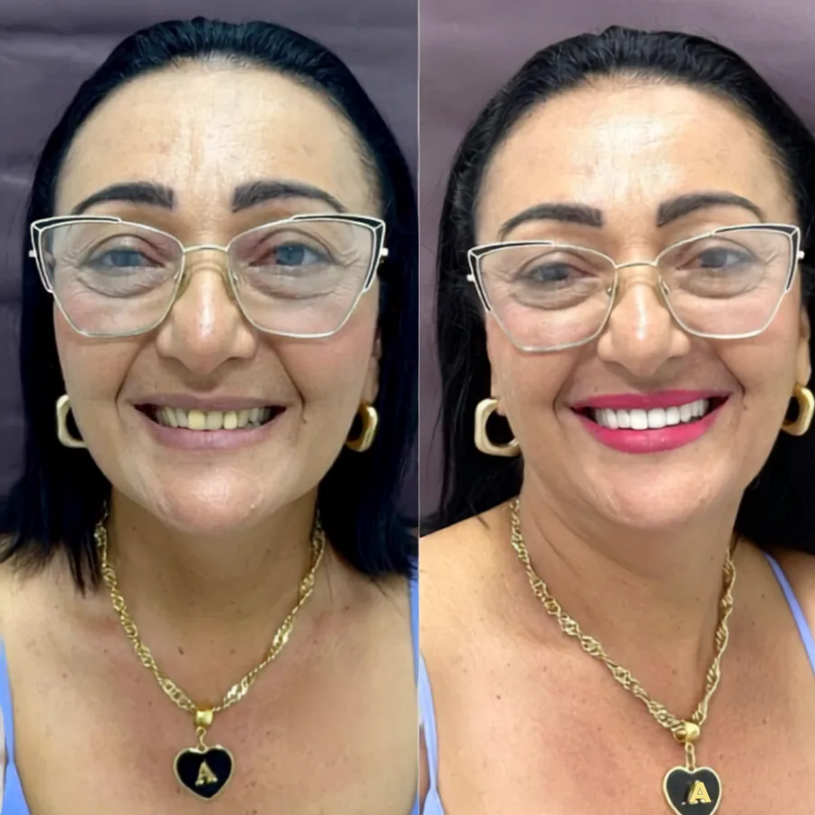Antes e depois de reabilitação do sorriso com prótese fixa