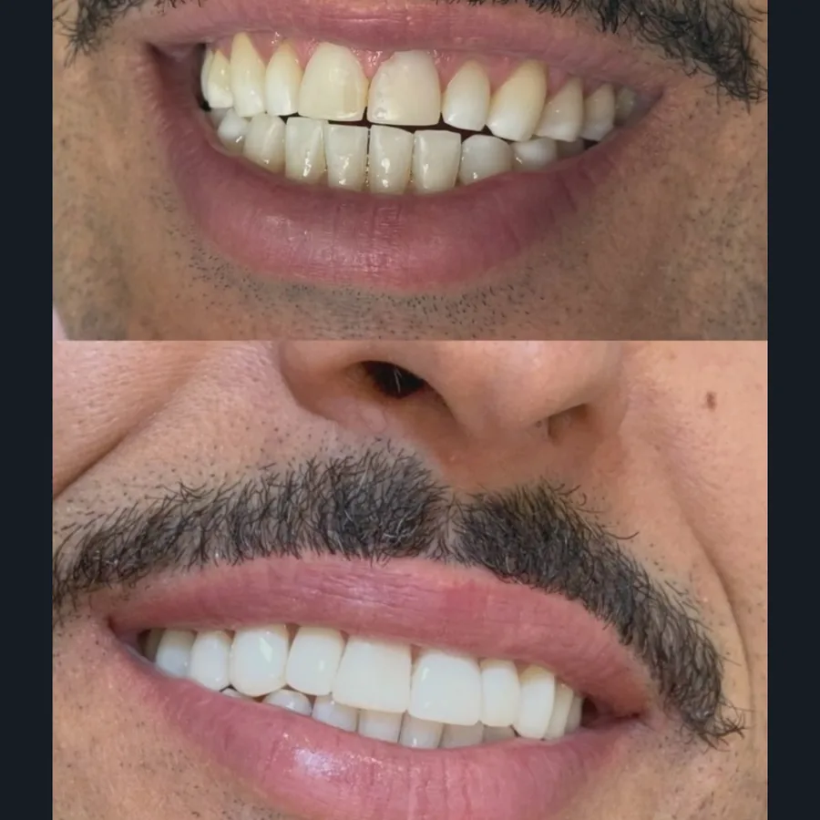 Antes e depois de reabilitação oral completa