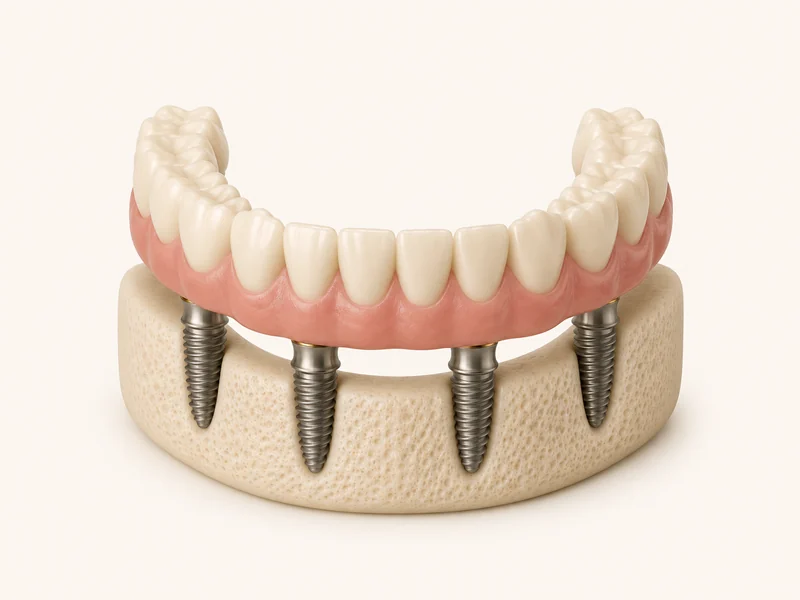 Protocolo: arcada completa fixa apoiada sobre quatro implantes de titânio